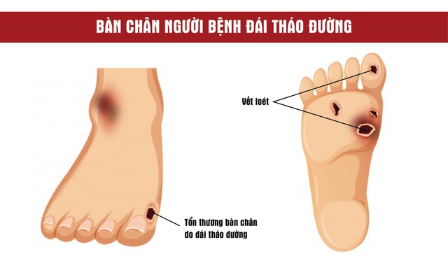 biến chứng thần kinh ở người tiểu đường