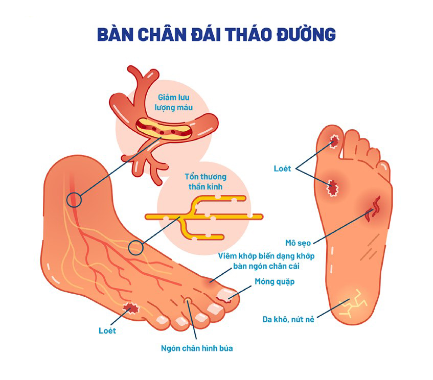 Sữa tiểu đường Gluzabet