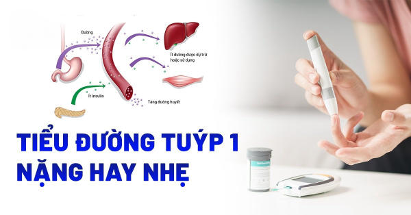 Tiểu đường tuýp 1 là nặng hay nhẹ?