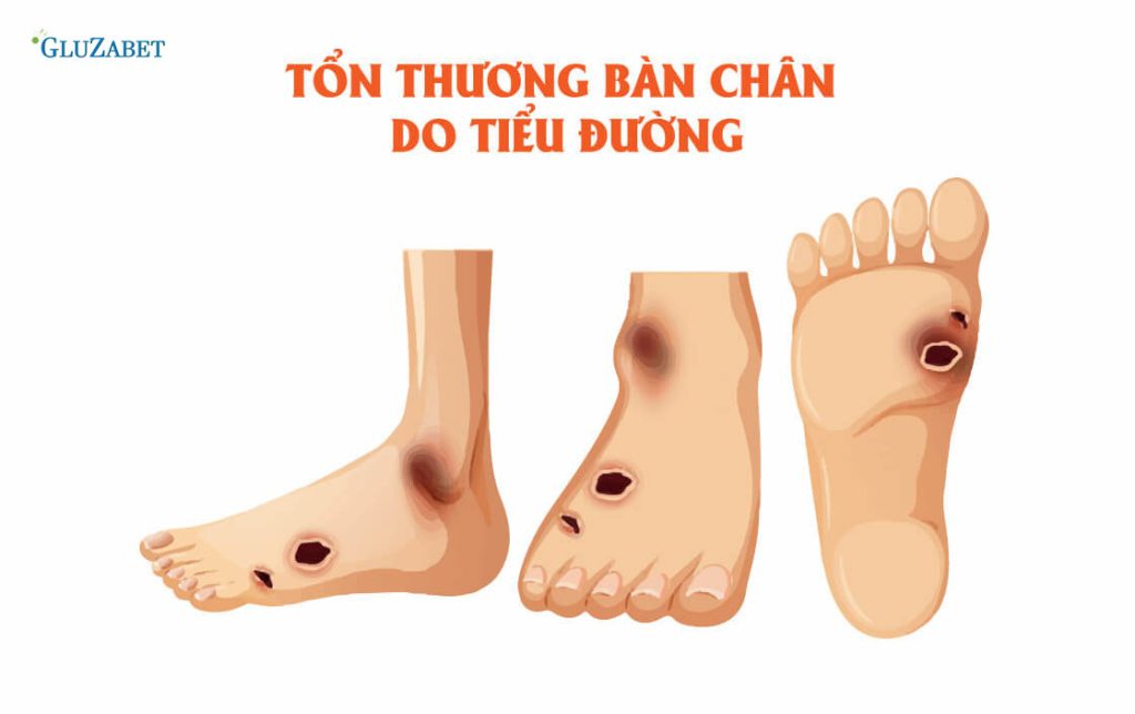 Tổn thương bàn chân do biến chứng tiểu đường