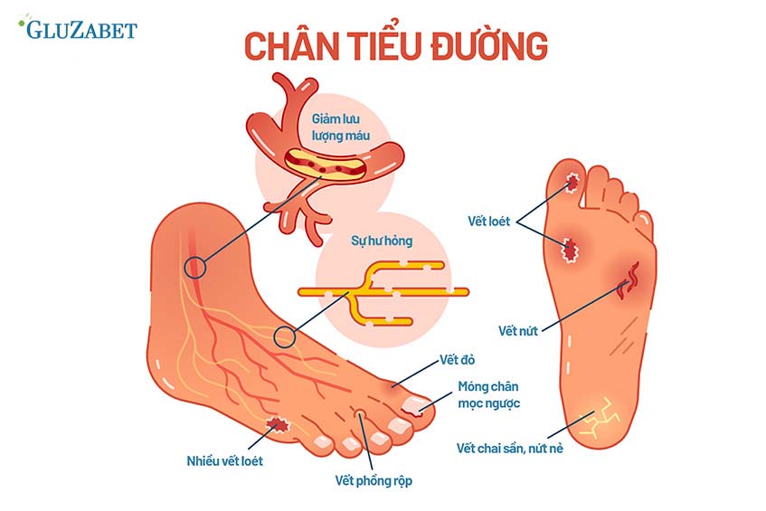 Phòng ngừa biến chứng bàn chân do tiểu đường