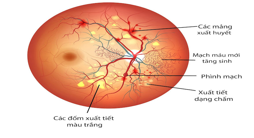 biến chứng mạch máu nhỏ của bệnh tiểu đường